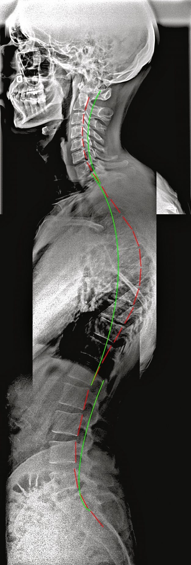 Kyphosis without SpineCor
