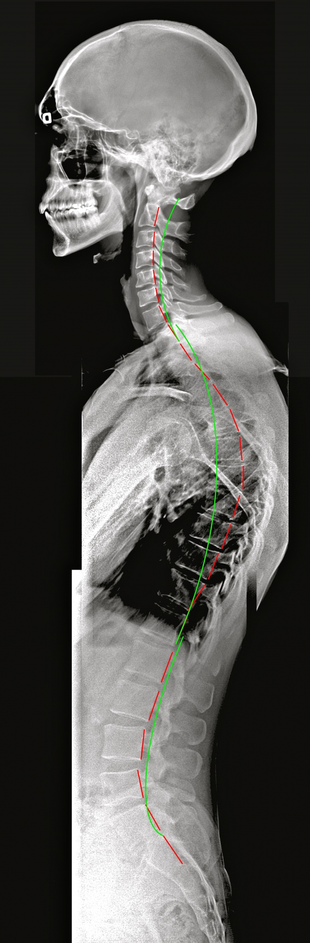 Kyphosis with SpineCor