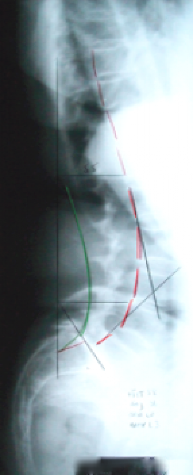 Radiographie avec le corset SpineCor