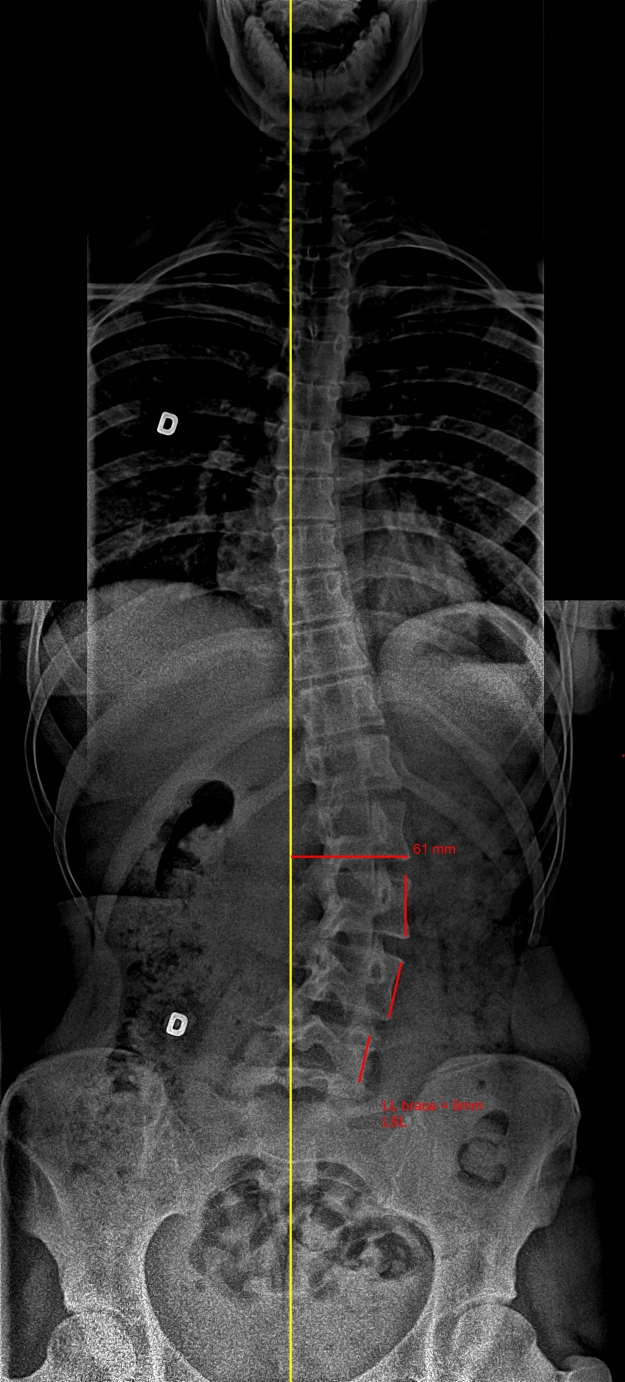 Radiographie avec le corset SpineCor