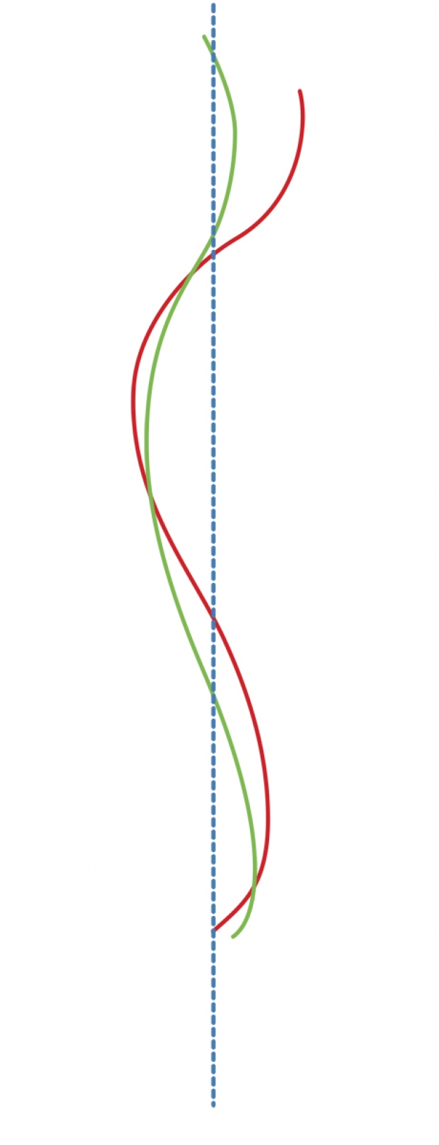 Type III hyperkyphosis