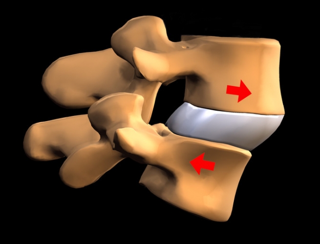 Spondylolistèse