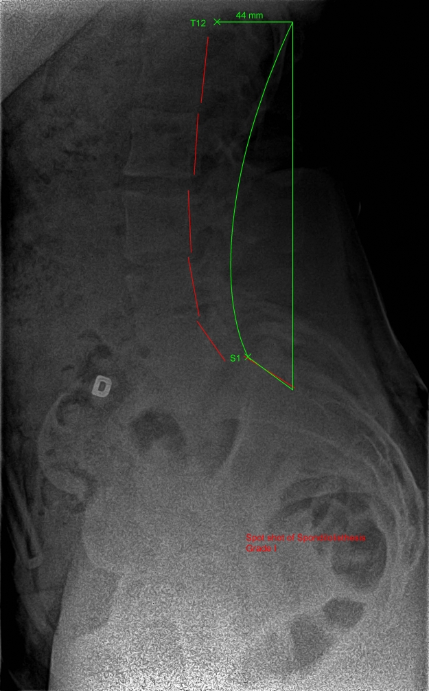 Radiographie d’une antérolisthèse (spondylolisthèse)