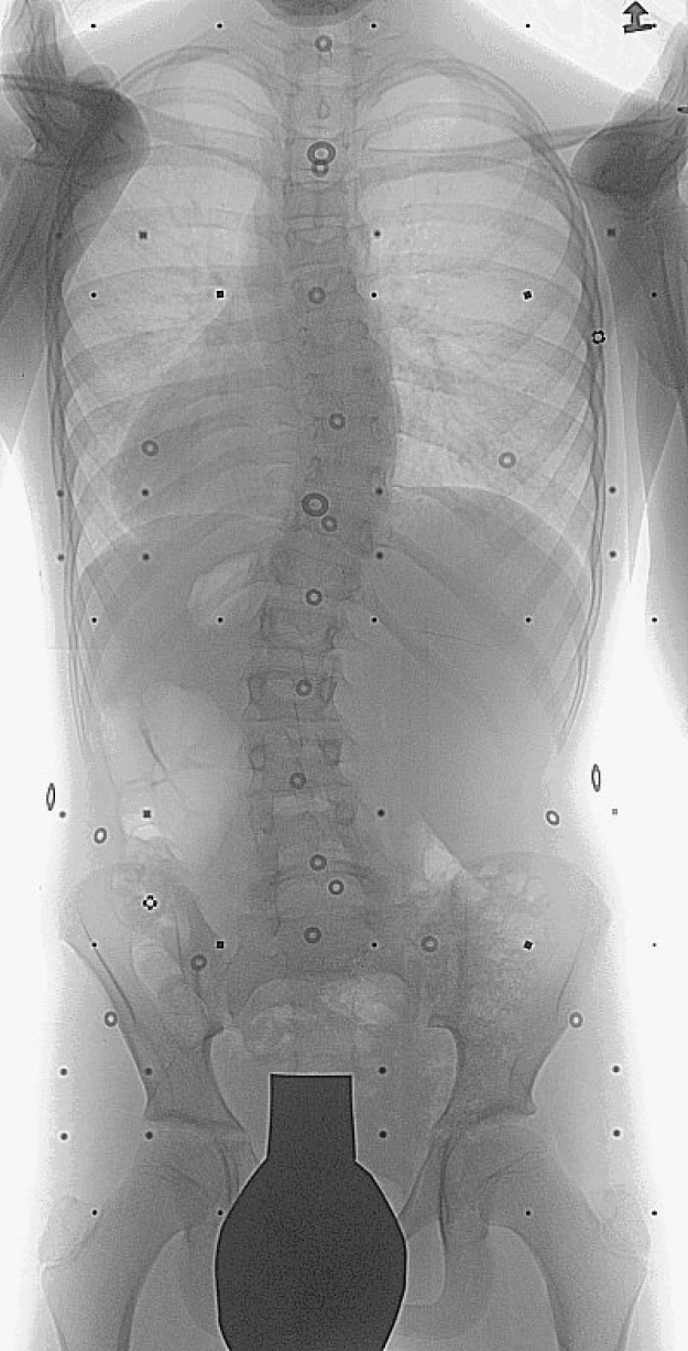 X-ray of a scoiiosis