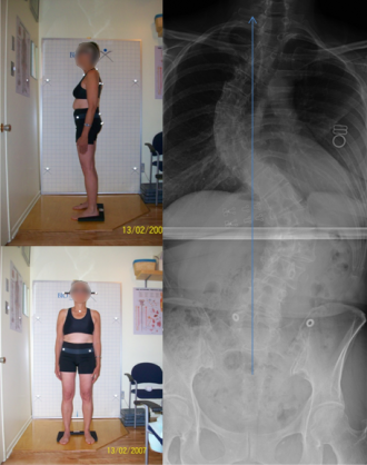 Adolescent idiopathic scoliosis in adults