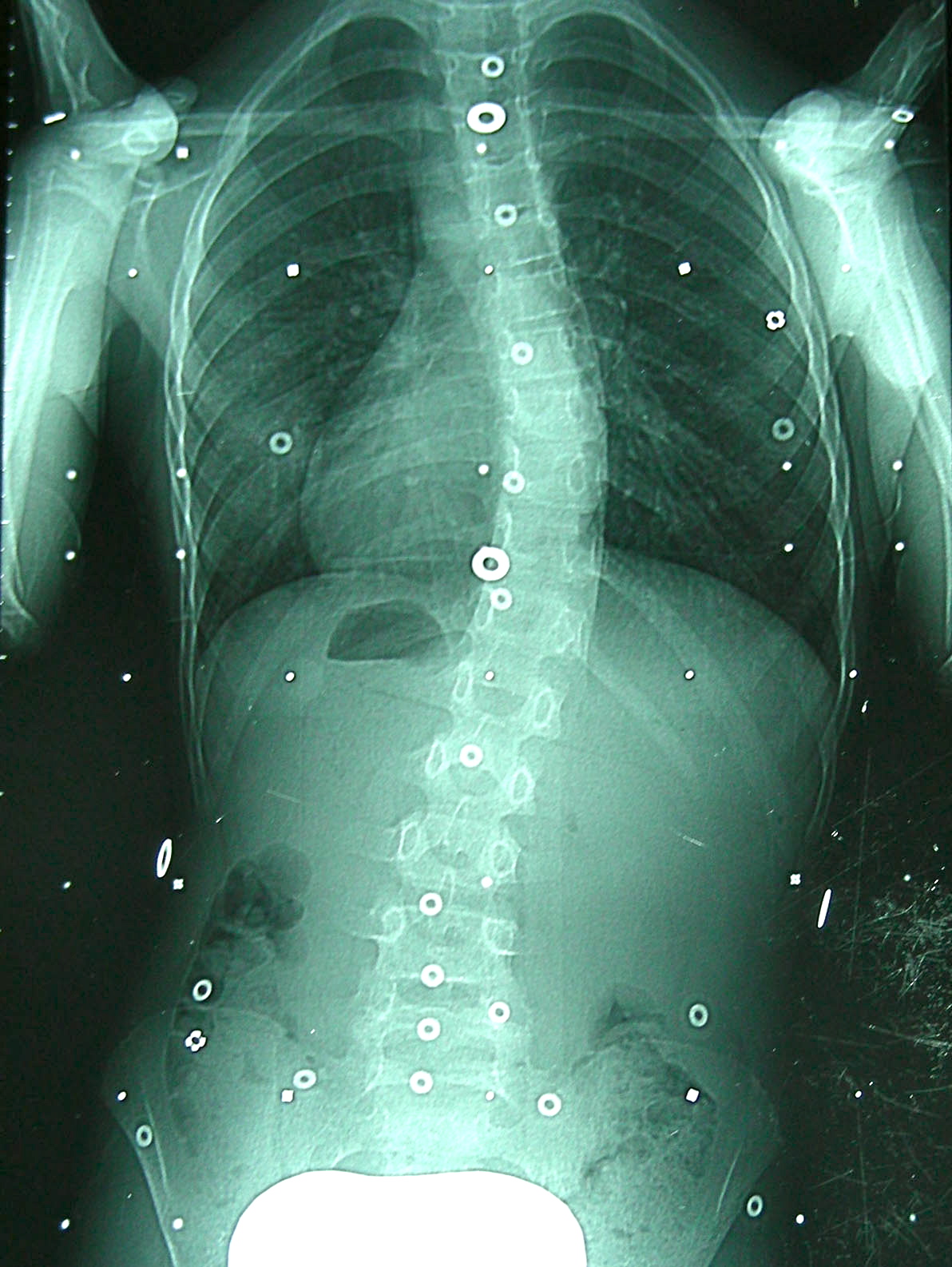 X-ray before treatment  