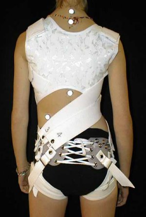 SpineCor® brace set up for type I right thoracic scoliosis