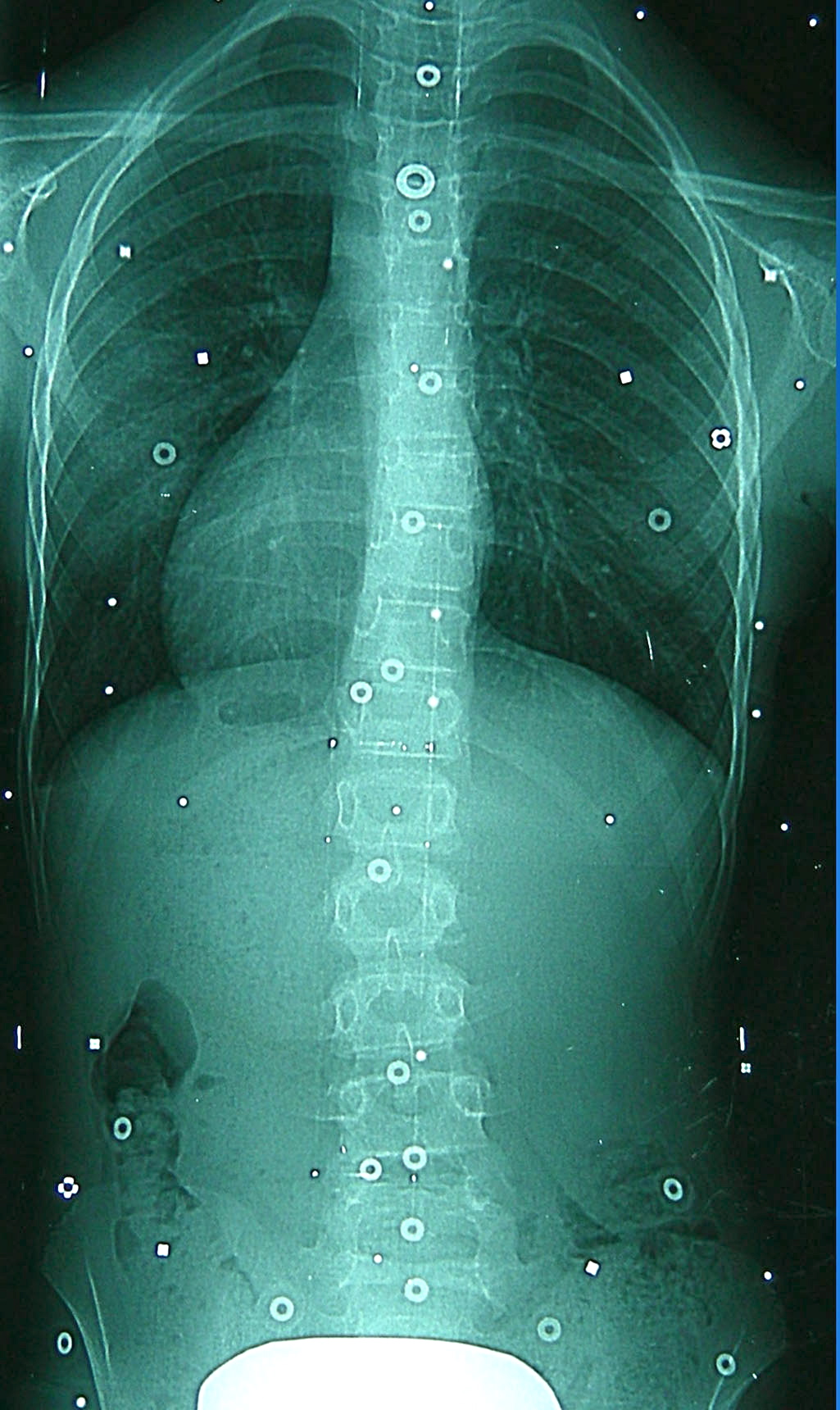 X-ray at removal after 15 months