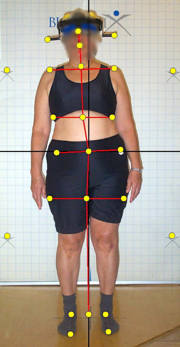 Frontal view without SpineCor® brace