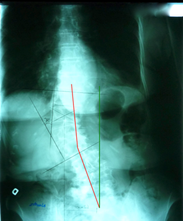 Radiographie sans le corset SpineCor