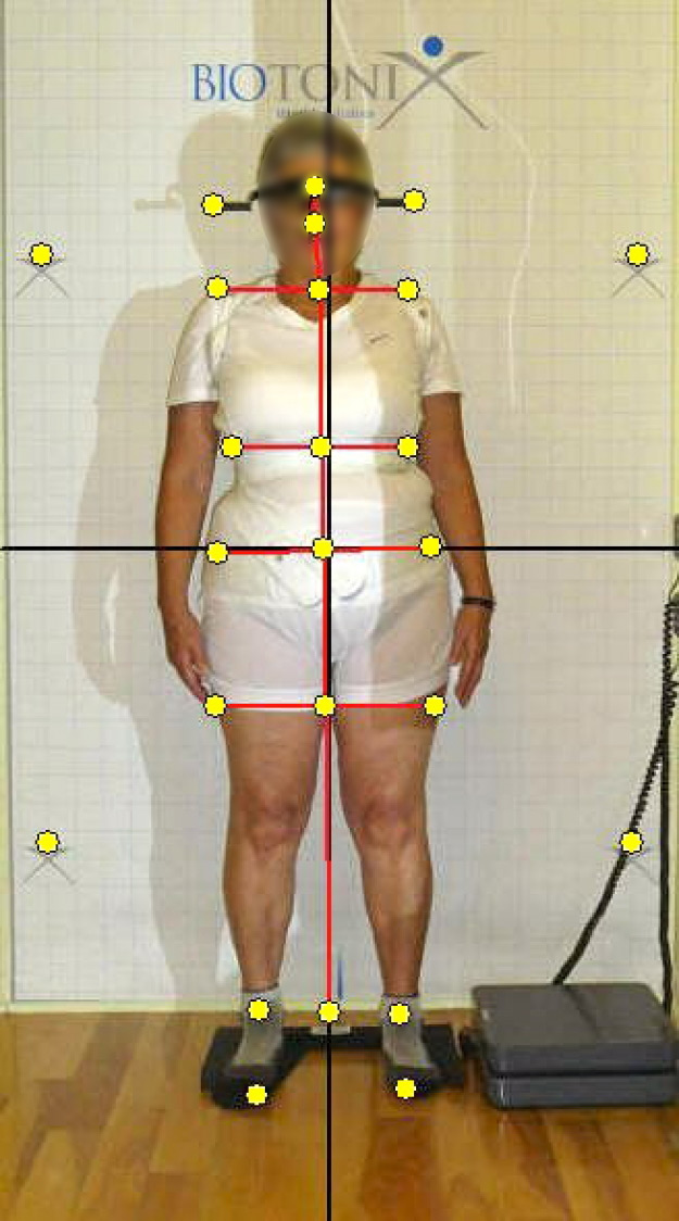 Frontal view with SpineCor® brace