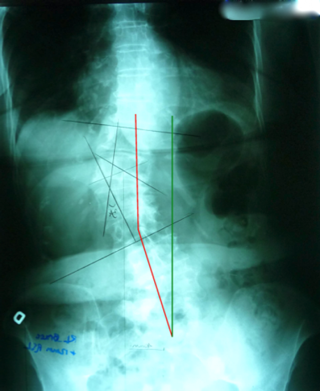 Radiographie avec le corset SpineCor