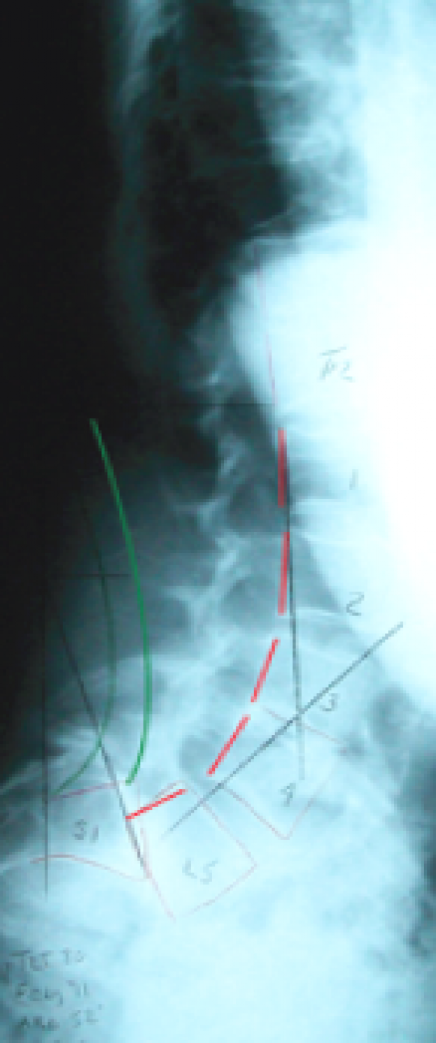 Radiographie sans corset
