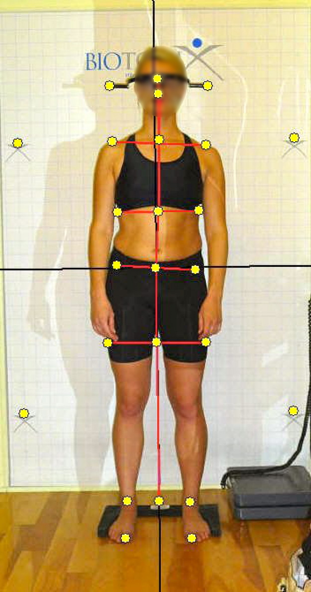 Frontal view without SpineCor® brace