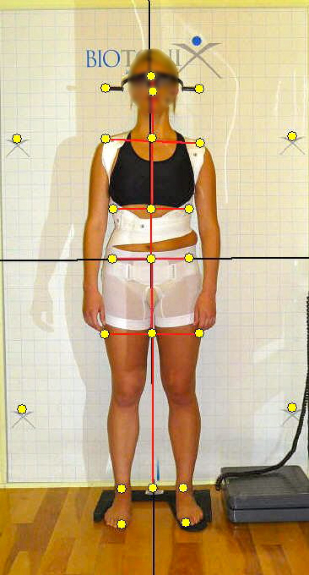 Frontal view with SpineCor® brace