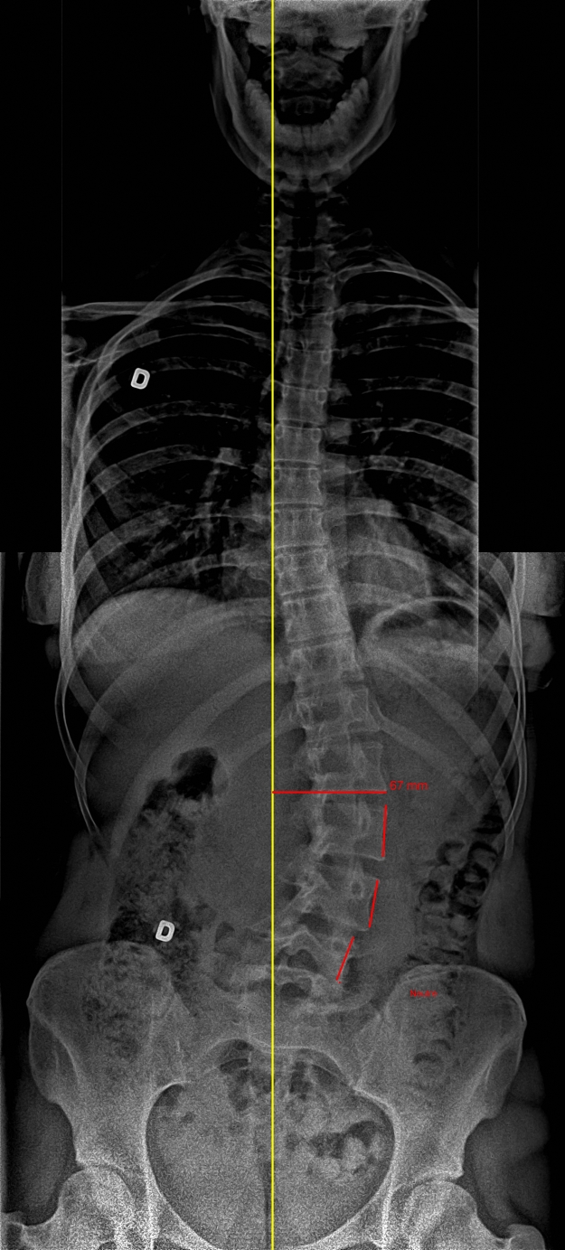 X-ray without SpineCor® brace