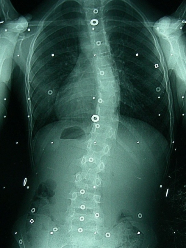 X-ray of a scoliosis