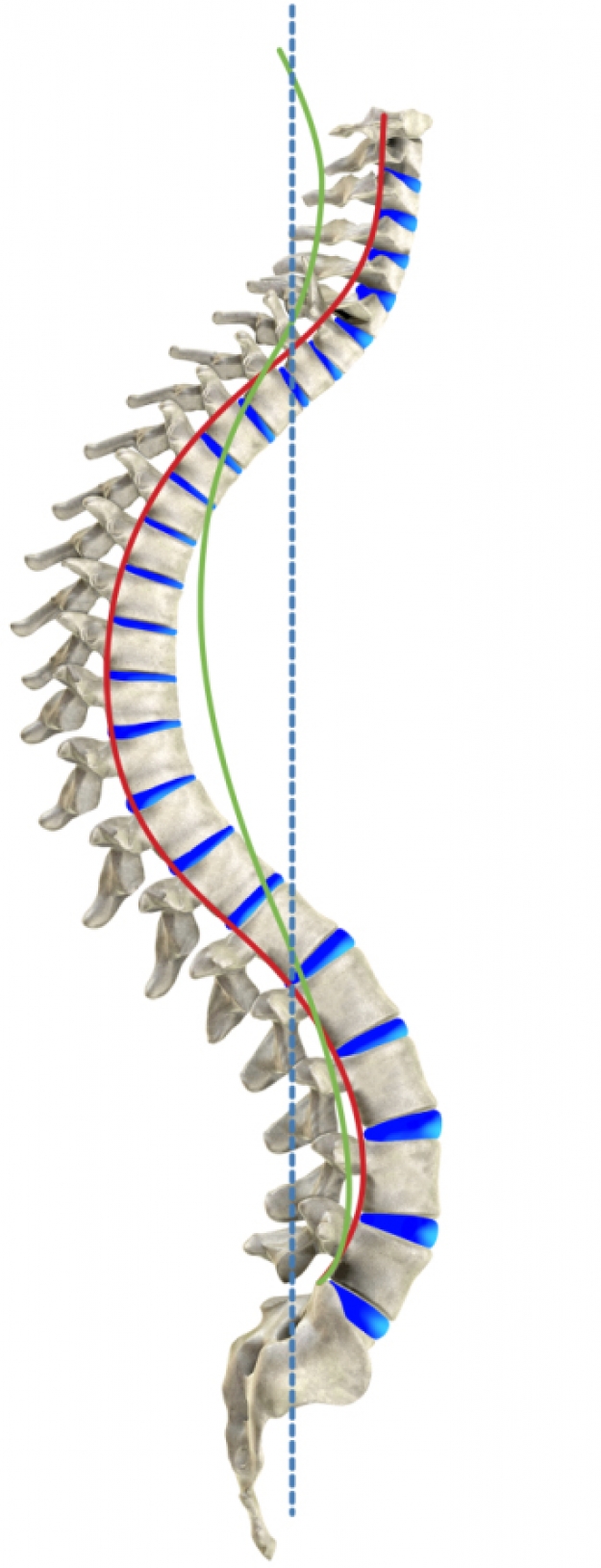 Hyperkyphosis