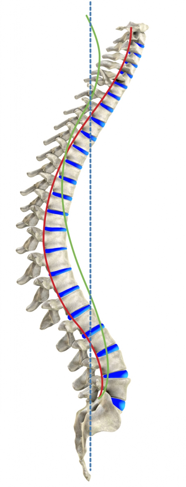 Type I hyperkyphosis