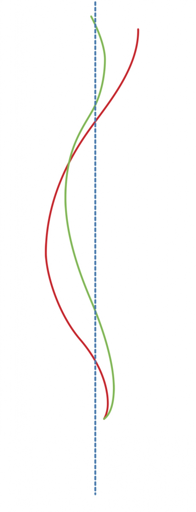 Type I hyperkyphosis