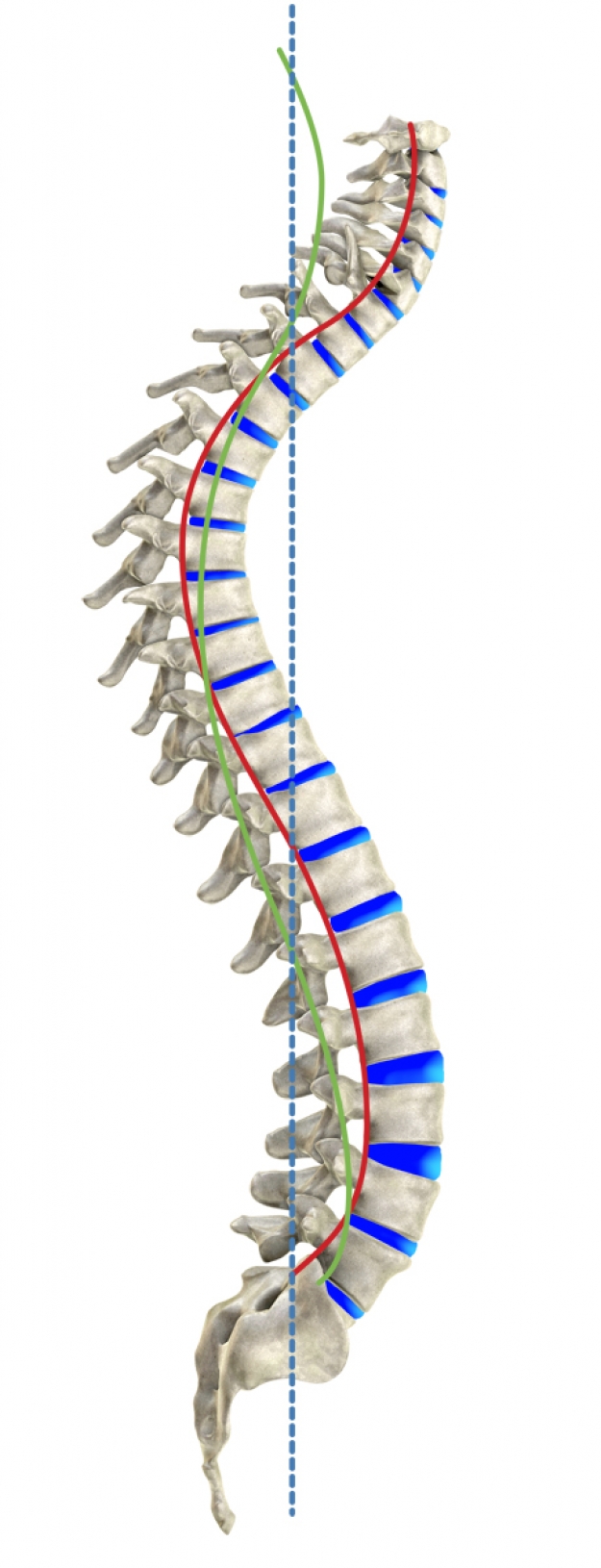 Type III hyperkyphosis