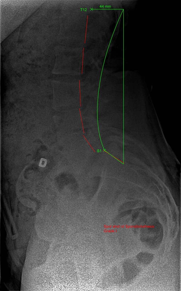 X-ray of an anterolisthesis (spondylolisthesis)