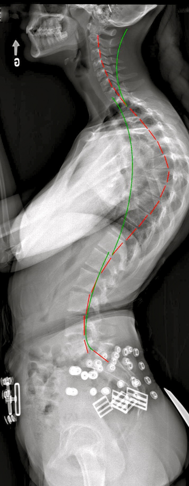 Hyperkyphosis with brace