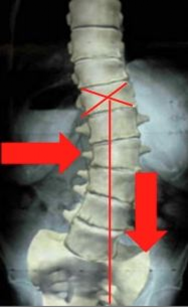 Force de gravité sur une colonne vertébrale anormale