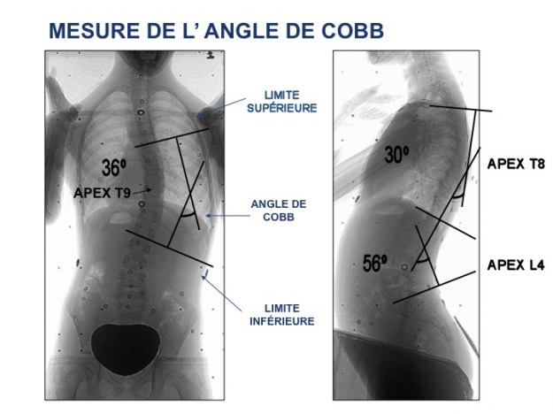 Mesure de l'angle de Cobb