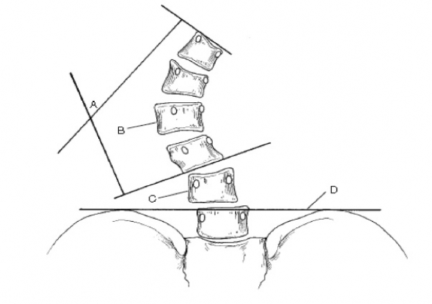 Schéma de Tribus illustrant les principaux facteurs de risques de progression de la scoliose dégénérative.