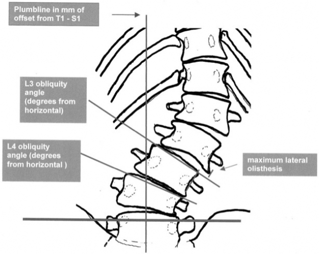 Illustration of a lateral listhesis by Schwab