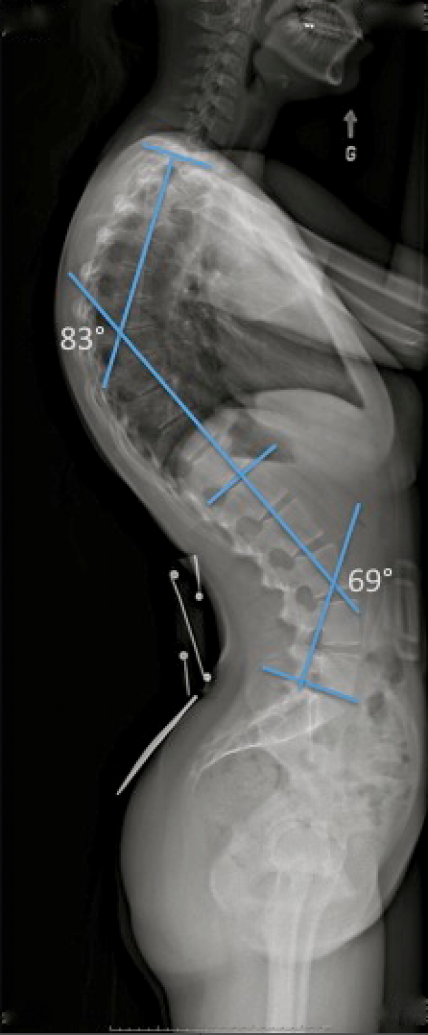 X-ray of hyperkyphosis