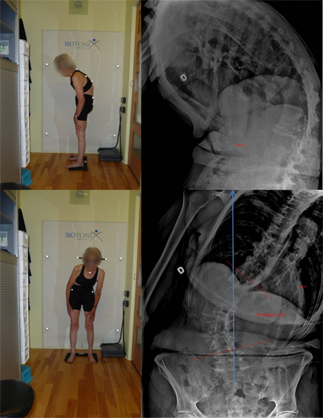 Adult degenerative scoliosis (de novo)