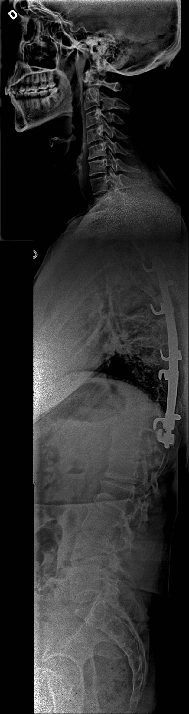 Lateral view of a vertebral fusion