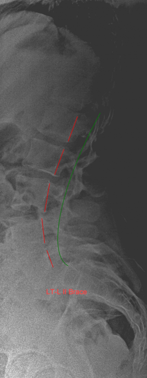 Isthmic spondylolisthesis (anterior)