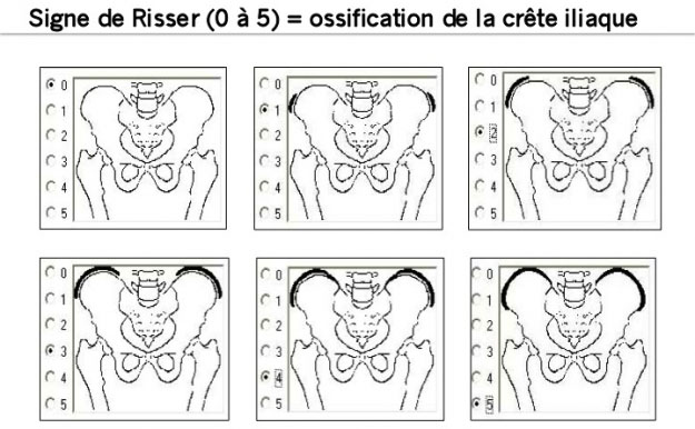 Signe de Risser