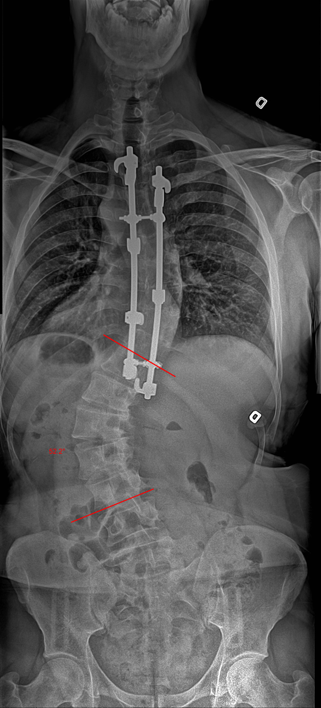 The metal rods used to stabilize vertebral fusion in a scoliosis patient are visible in this x-ray.