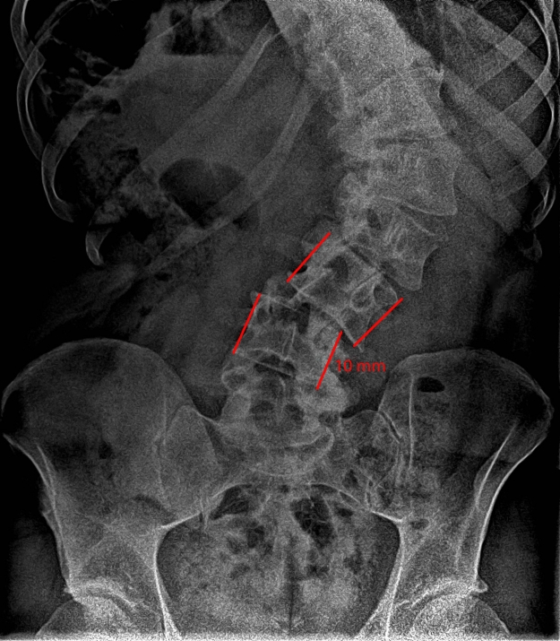 X-ray of a lateral listhesis (rotational subluxation)