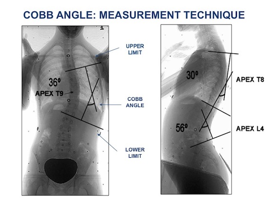 Cobb angle measurement
